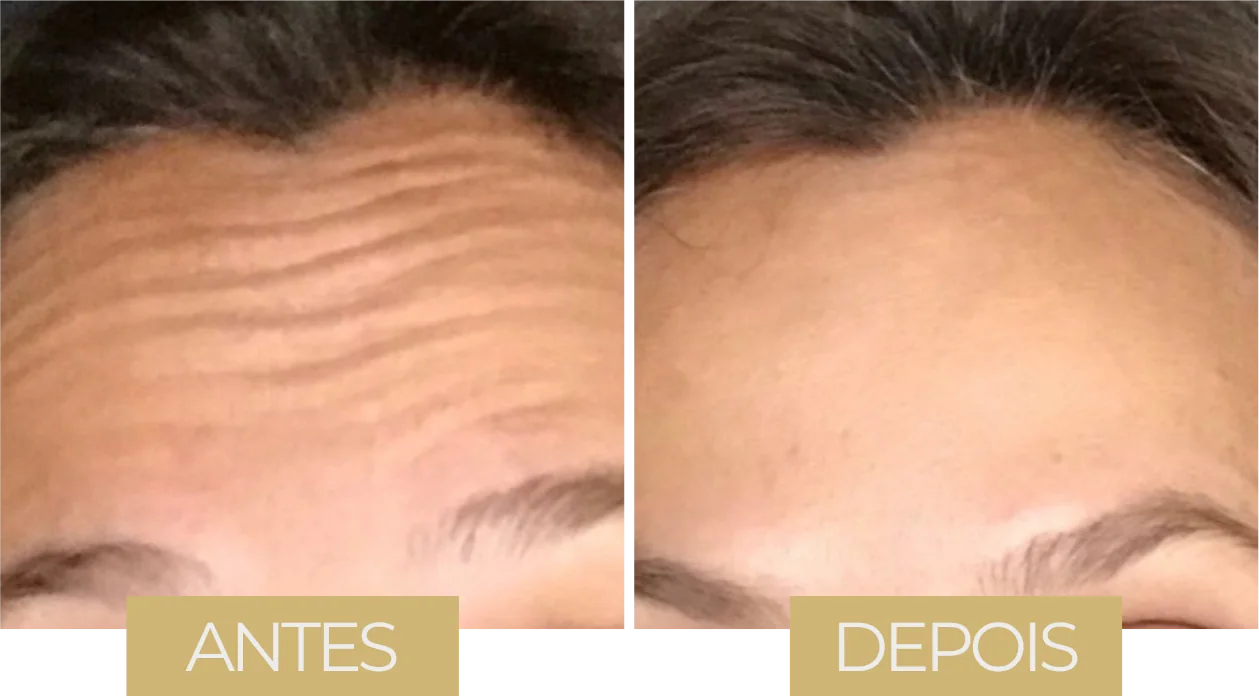Toxina Botulínica LVB — antes e depois, caso 1