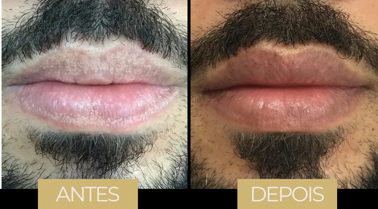 Fordyce por LVB — antes e depois, caso 3