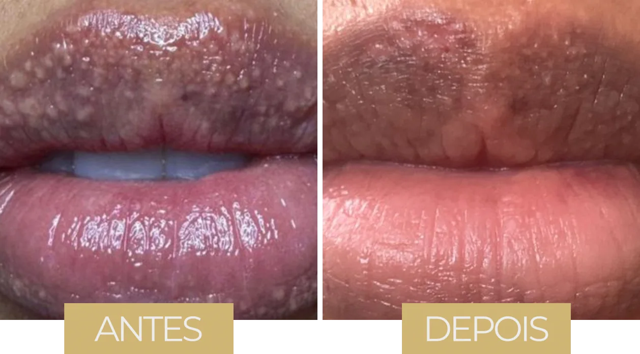 Fordyce por LVB — antes e depois, caso 4