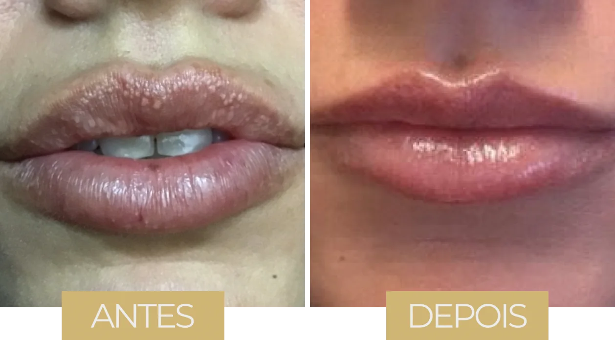 Fordyce por LVB — antes e depois, caso 5