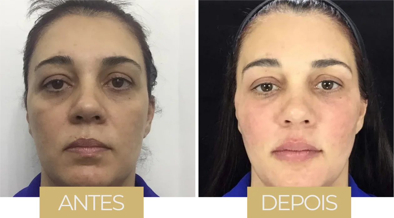 MD Codes — antes e depois, caso 1