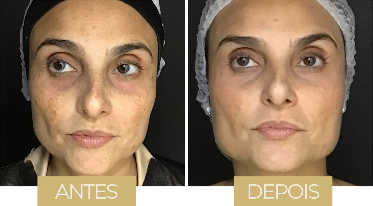 MD Codes — antes e depois, caso 3
