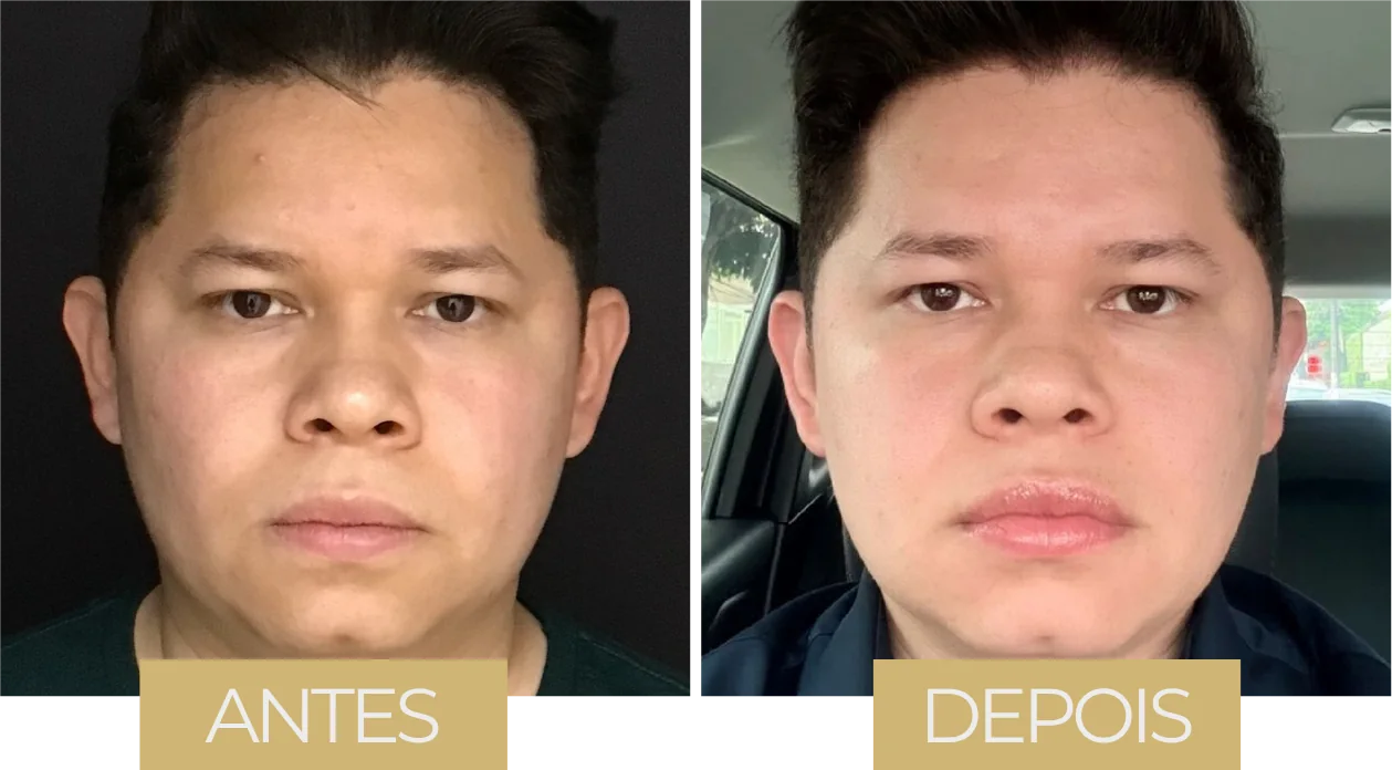 Ultraformer MPT — antes e depois, caso 2