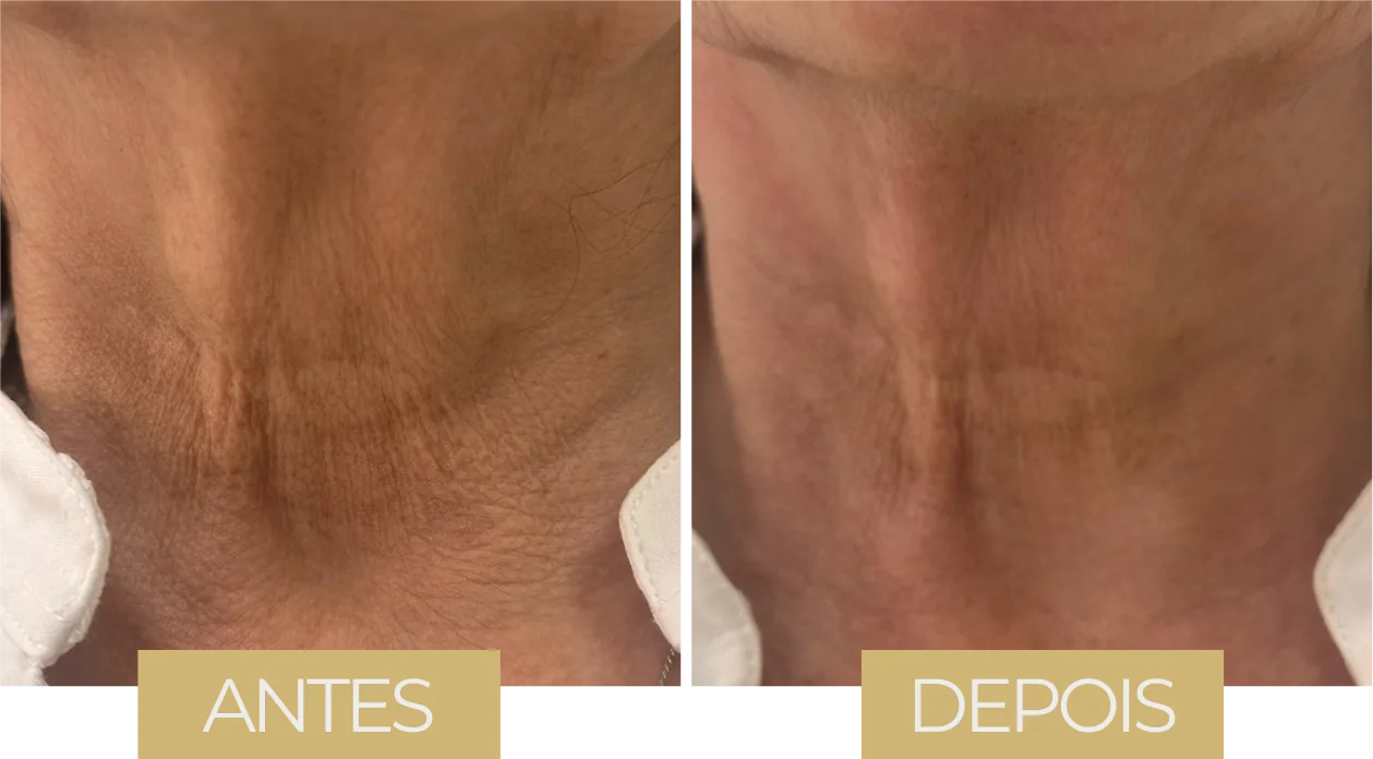 Volnewmer — antes e depois, caso 1