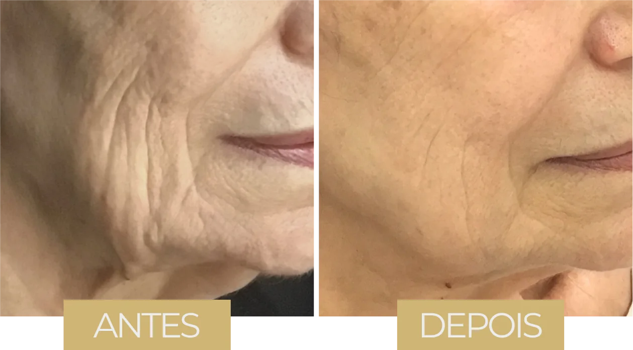 Volnewmer — antes e depois, caso 2